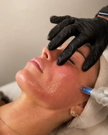 Profissional de luvas pretas fazendo microagulhamento no rosto de uma cliente na Ellevare